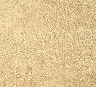 显微镜真菌性角膜炎照片鉴赏